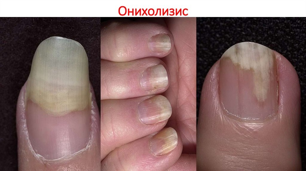 наглядный онихолизис