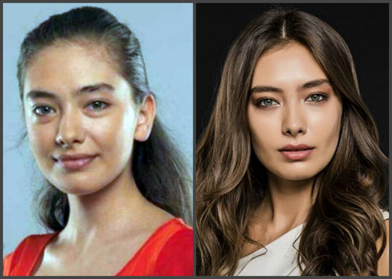 НЕнастоящая красота: кто из турецких актрис делал пластику? (фото до и после операций)