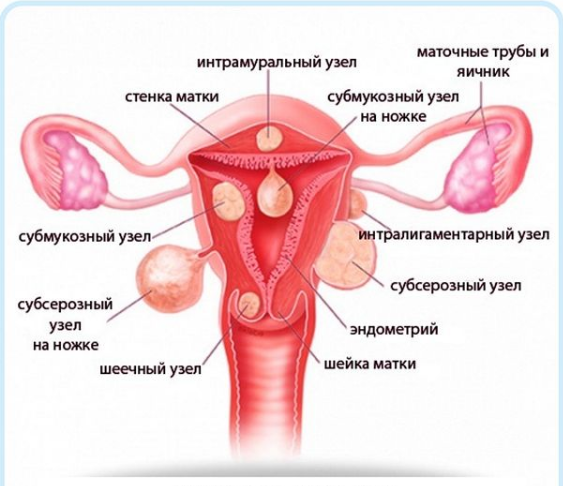 Миома на задней стенке матки