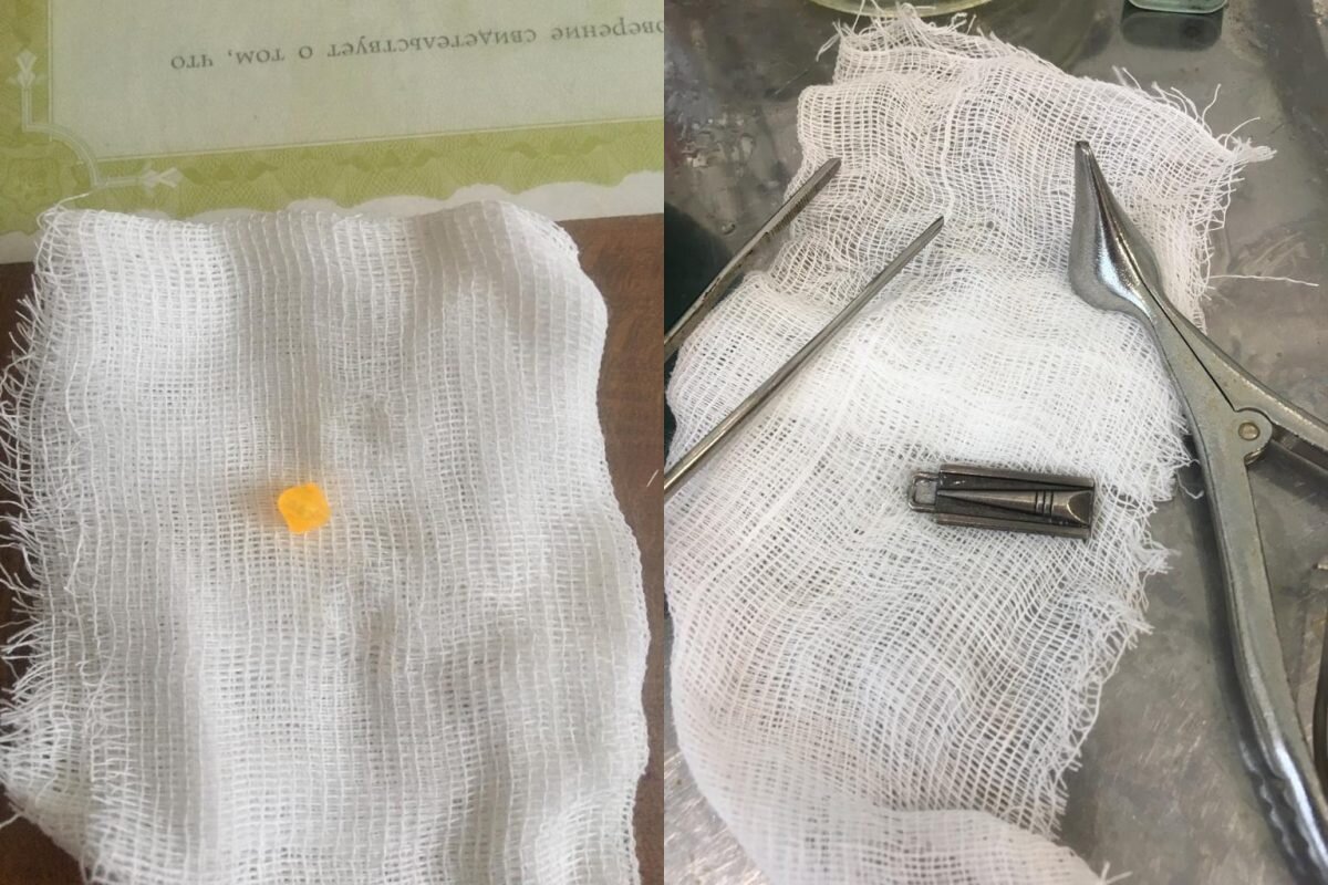    За три дня специалисты достали застежку от молнии и бусинку из носов Арина Полтанова