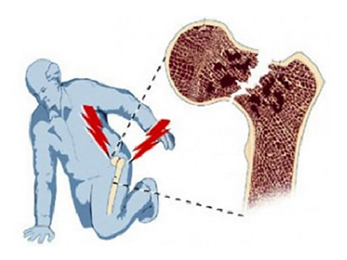 Перелом бедра рисунок