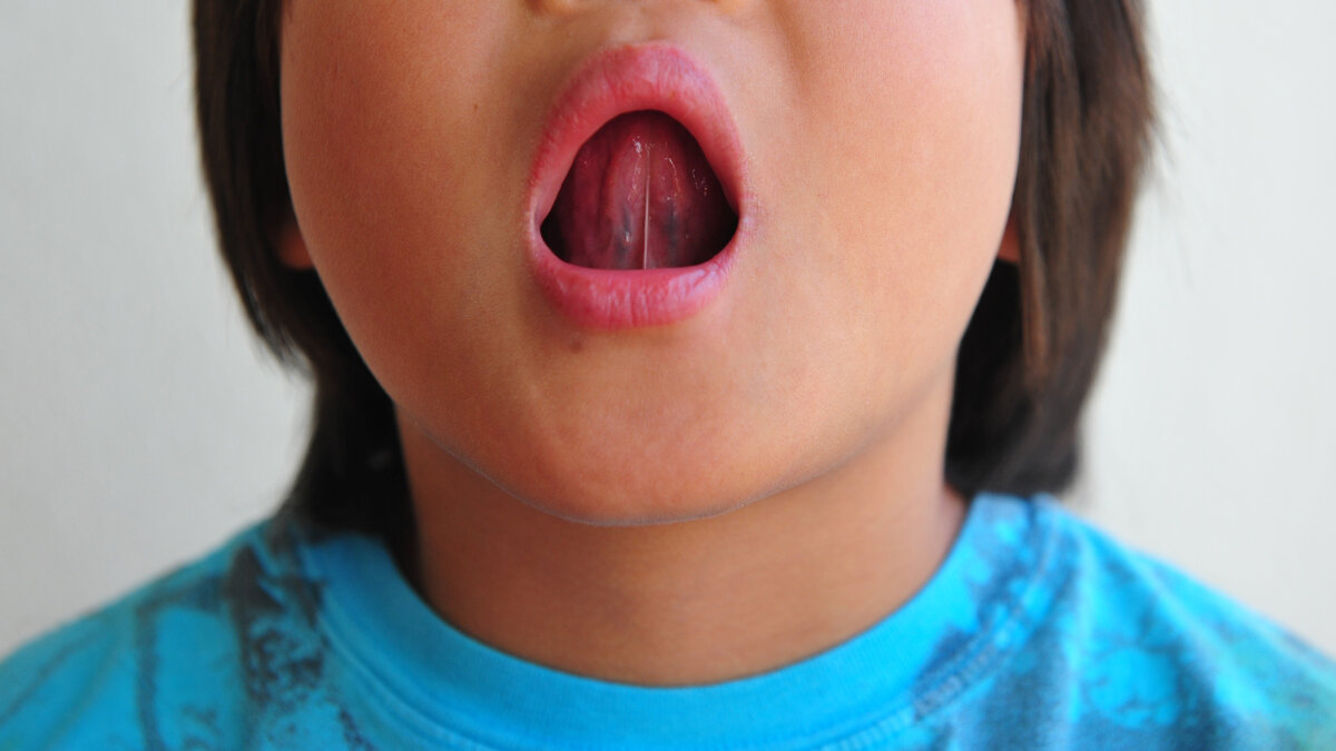 Патологии уздечки языка и современные способы решения проблемы