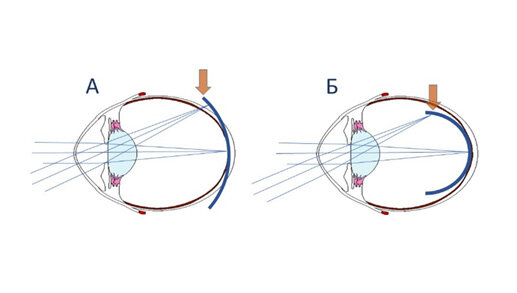 Периферический дефокус при коррекции сферической контактной линзой (А)  и дефокусной (бифокальной) линзой (Б)

