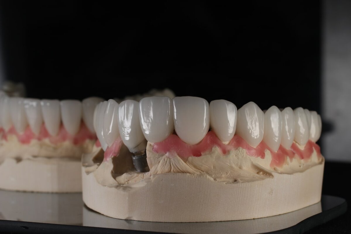На данной фотографии воск толщиной примерно 0.5-1мм, что не совсем красиво, но все же выглядит симпатично, а представьте если бы десна была 1.5-2мм? Насколько удобнее было бы технику в работе? 