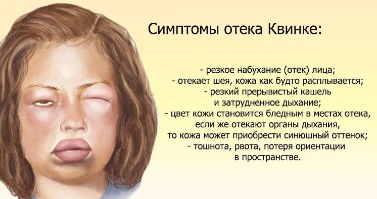 Отёк Квинке: особенности и первая помощь