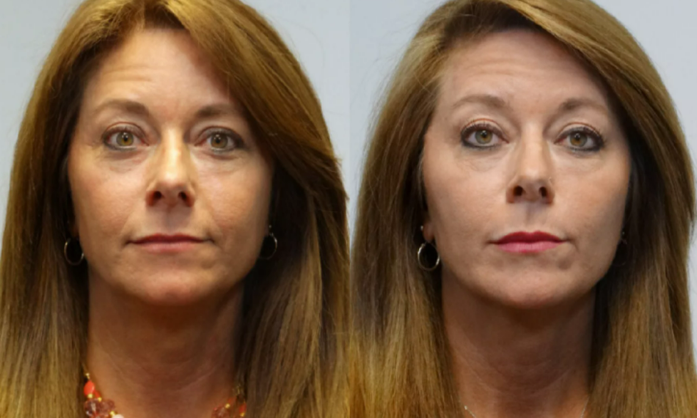 ботокс можно ли заниматься спортом. ботокс после 50-ти лет фото. мезоботокс гусиные лапки. ботокс можно ли заниматься спортом. ботокс обои.