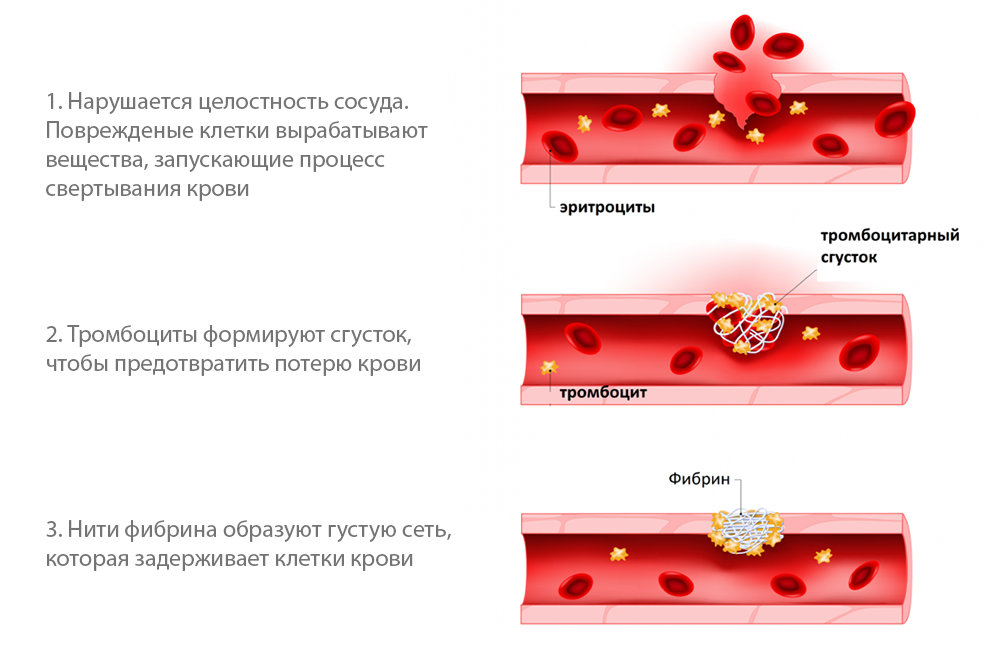 Так в процессе заживления после операций формируются тромбы