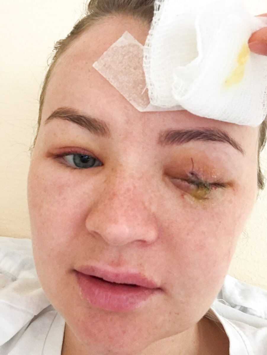 Неделя после удаления глаза. Выписка из НИИ Гельмгольца. | Акулий глаз ...