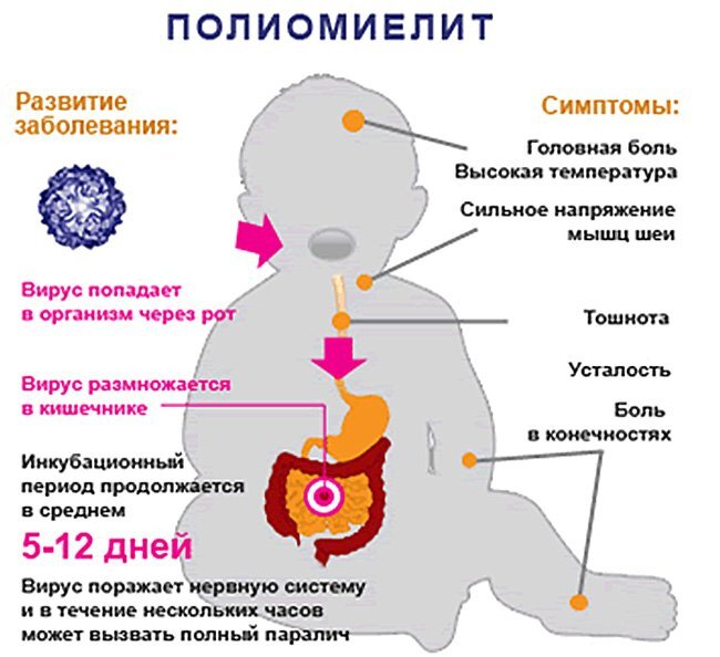 Полиомиелит у взрослых