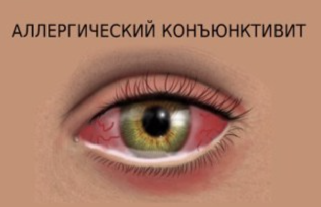 Коньюктивит глаз лекарство. Люди с красными глазами от природы фото. Герпесный конъюнктивит конъюнктивит. Коньюктивит глаз лекарство. Флоксал глазные капли для детей.
