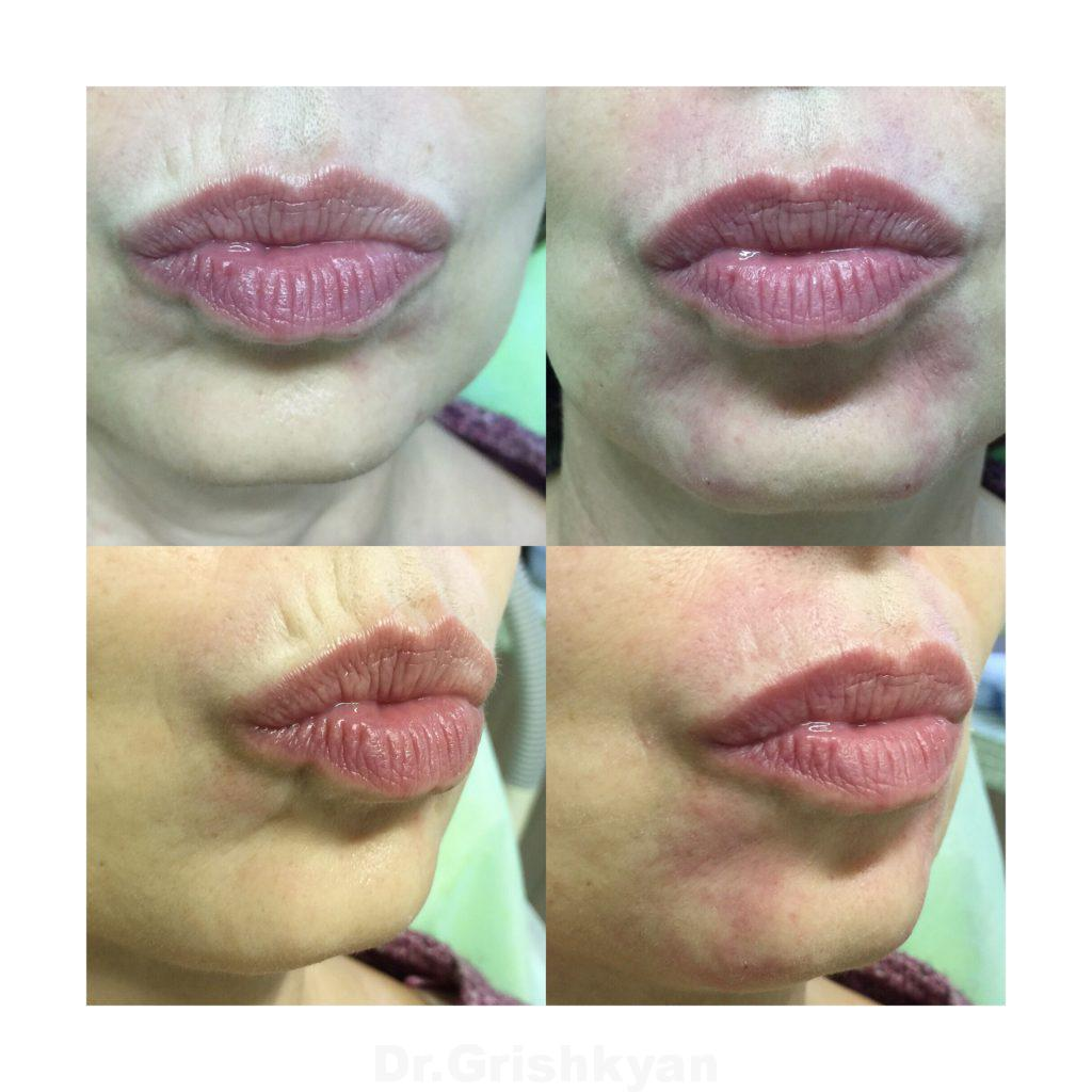 Кисетные морщины и методы их коррекции, фото с сайта хирурга Гришкяна Д.Р., имеются противопоказания, требуется консультация специалиста. 