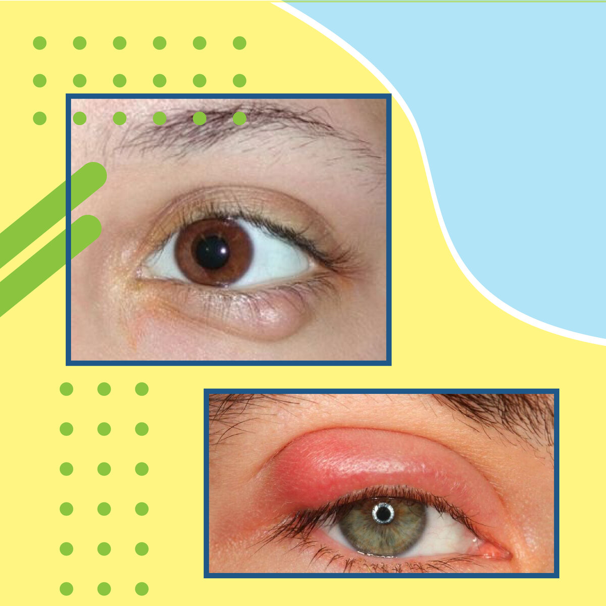 Так выглядит халязион