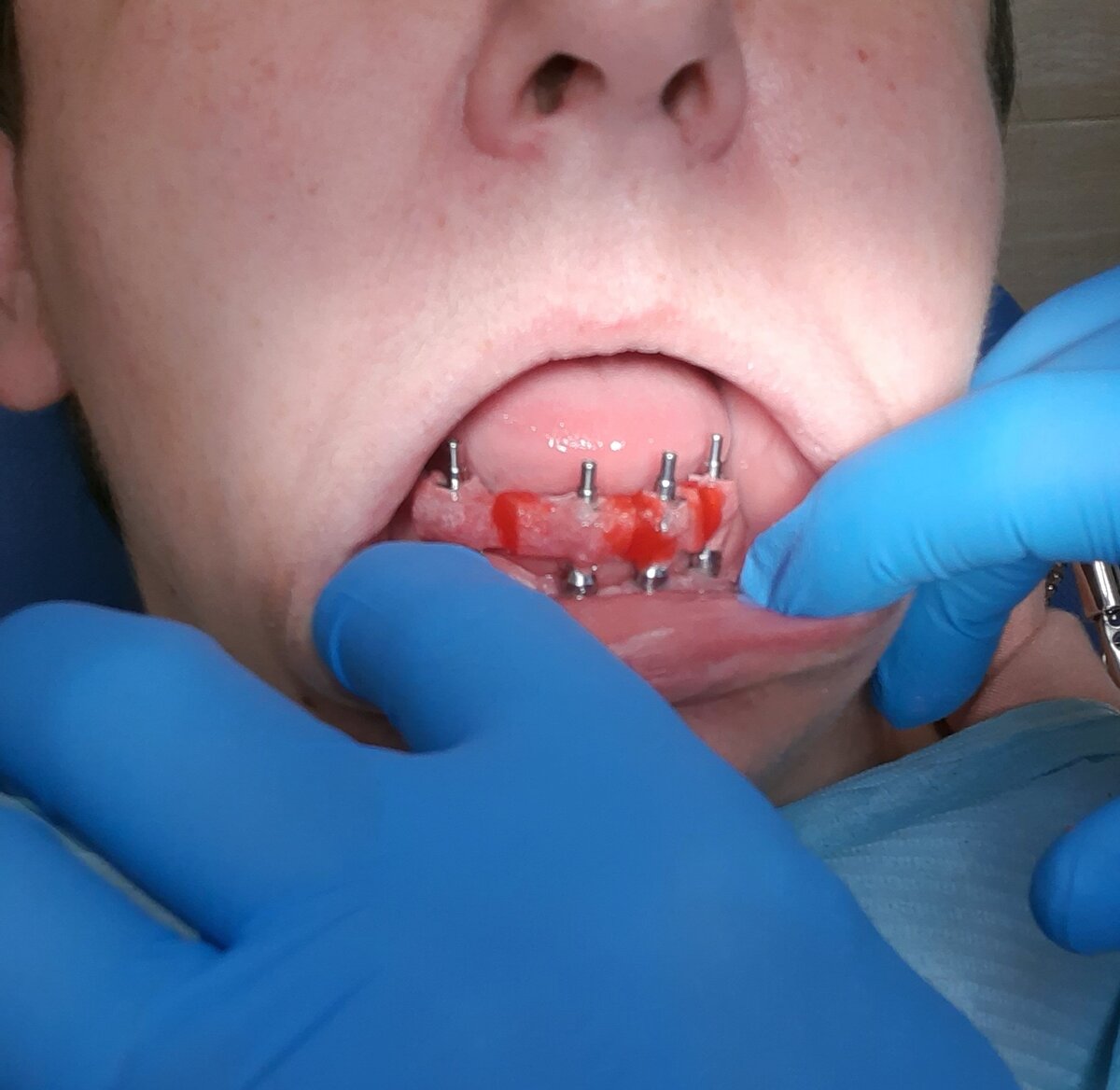 А это подготовка к точному слепку, импланты соединены с трансферами и зафиксированы специальной пластмассой, которая не дает усадки. Это позволяет снять оттиск с минимальными погрешностями.