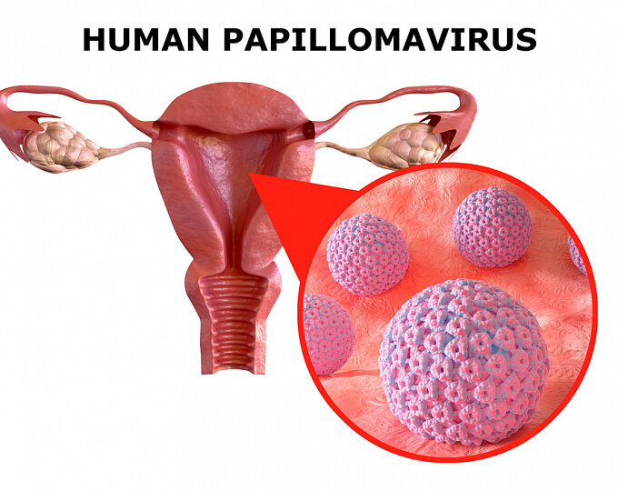 Папилломы на интимных местах