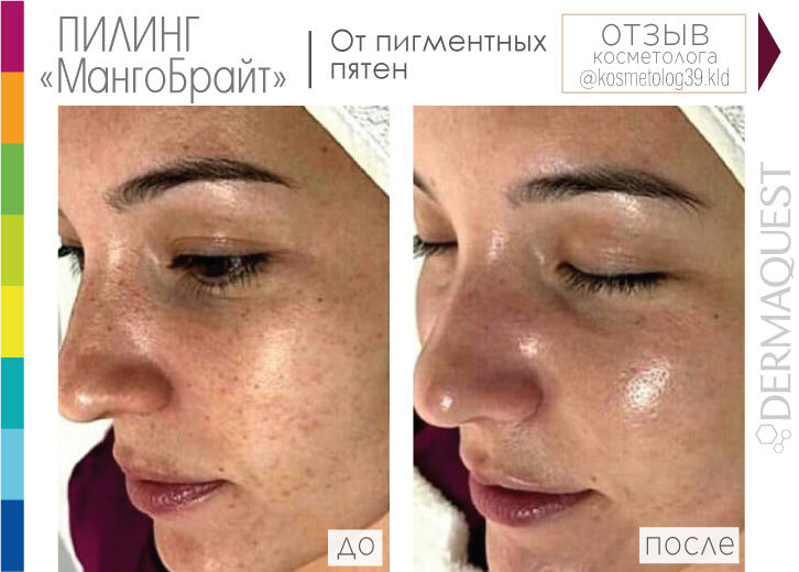 Лазерная шлифовка веснушек. Мезотерапия от пигментации на лице до и после. Пилинги от пигментации отзывы. Хлоазма,лентиго,мелазма. Пилинги от пигментации отзывы.