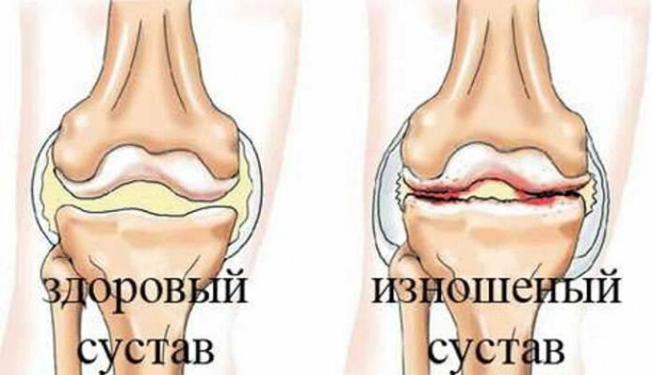 Вовсе не пустяк: как предотвратить и вылечить заболевания суставов