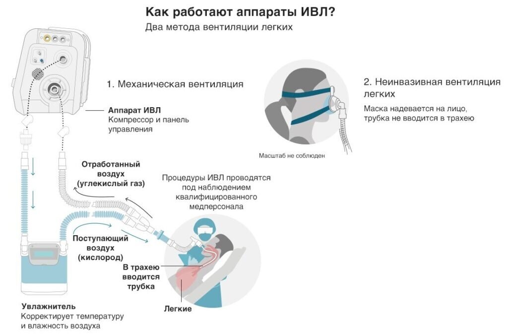 Как правильно подключить кислород Стадии коронавируса: какие существуют, изменения по дням Важно знать Дзен