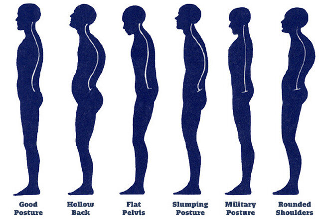 Пример нормы (1) и нарушений осанки.
