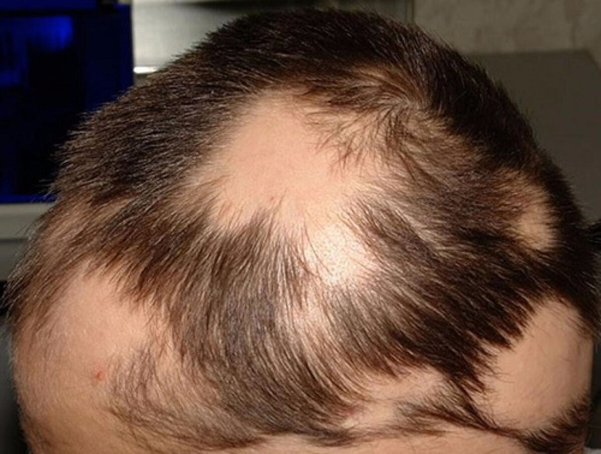 Пример очаговой алопеции