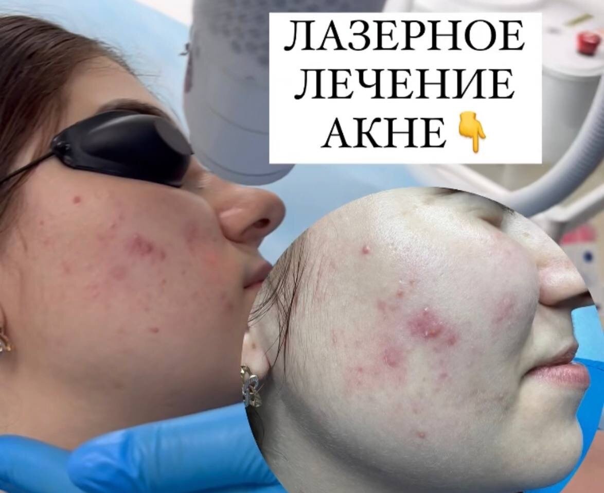Лечение акне неодимовым лазером Asclepion в Клинике доктора Григоренко (Владивосток)