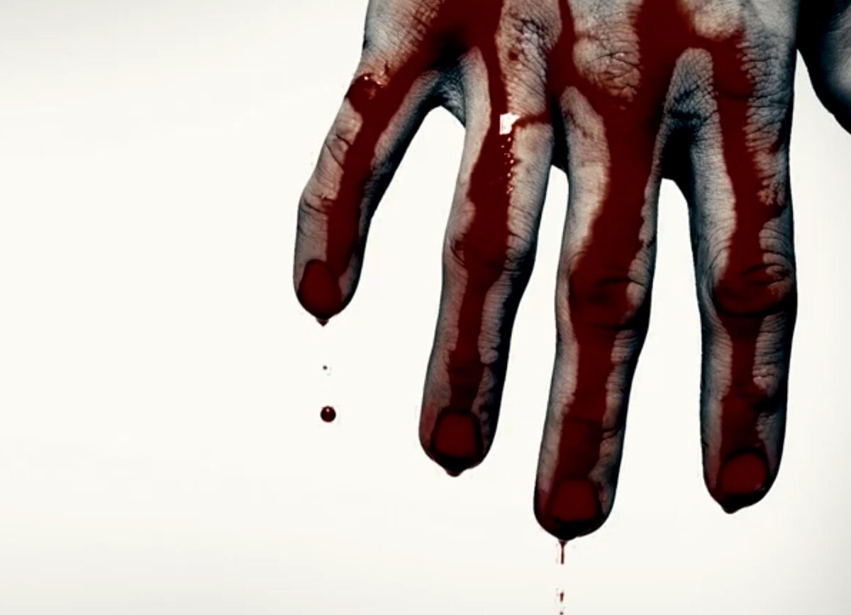 Кровотечение - угроза кровопотери и жизни. 