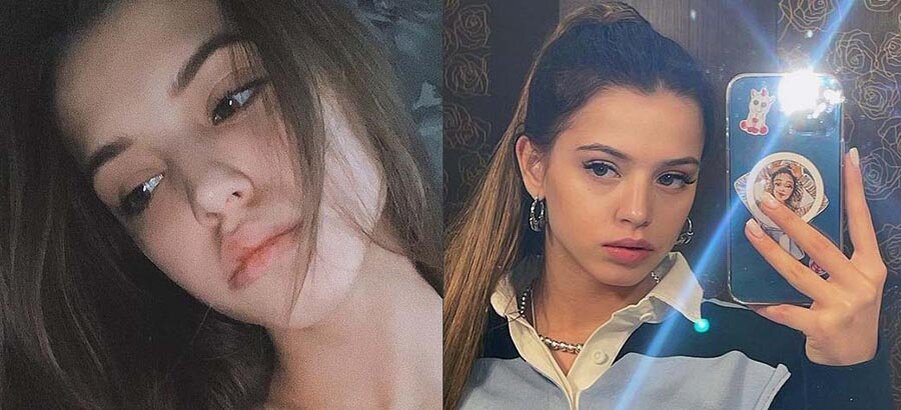 Юля гаврилина фото до и после пластики