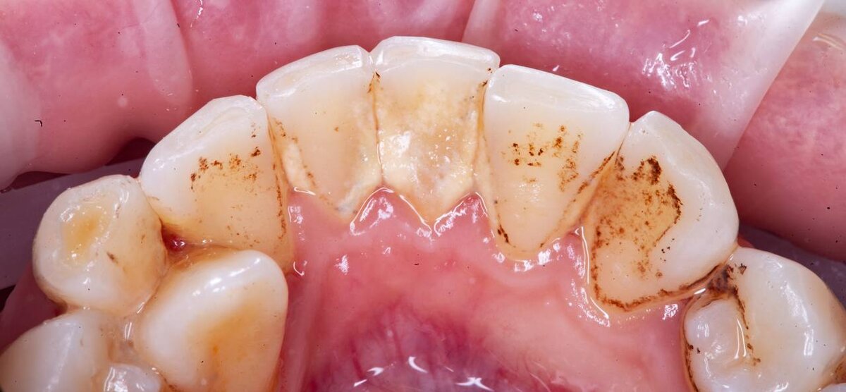 Эта фотопротокол - необходимый для стоматолога , чтобы наглядно показать пациенту отель проблемах в полости рта , а так же для проведения сравнения с результатом процедуры.