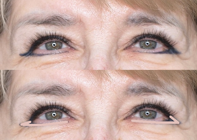 Маскировать татуаж нужно локально