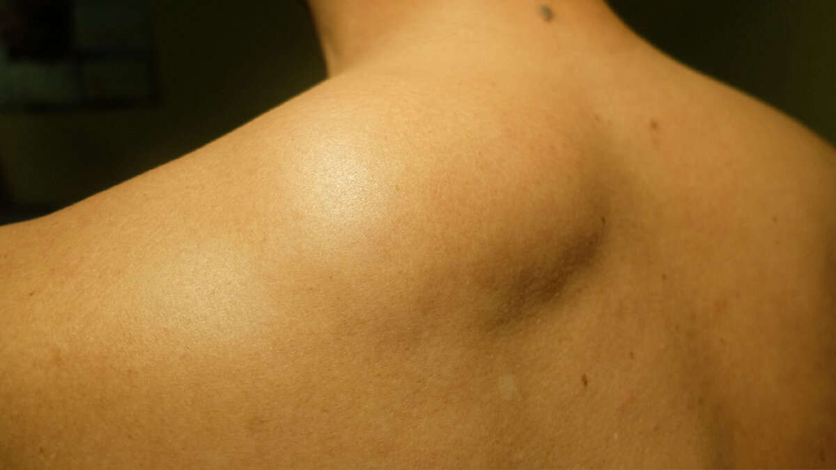 Липома спины (левой лопаточной области). Фото из открытых источников. 