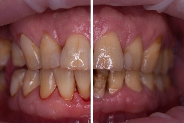 Зубы после и перед профессиональной чисткой зубов