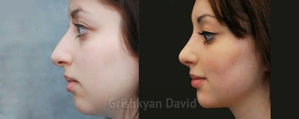 Коррекция подбородка липофилингом и ринопастика. Коррекция подбородка требуется в 40% случаев при ринопластике. Фото с сайта хирурга Д.Р,Гришкяна, имеются противопоказания, требуется консультация специалиста. 