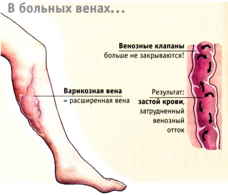 Варикоз- причины, симптомы, осложнения и методы лечения.