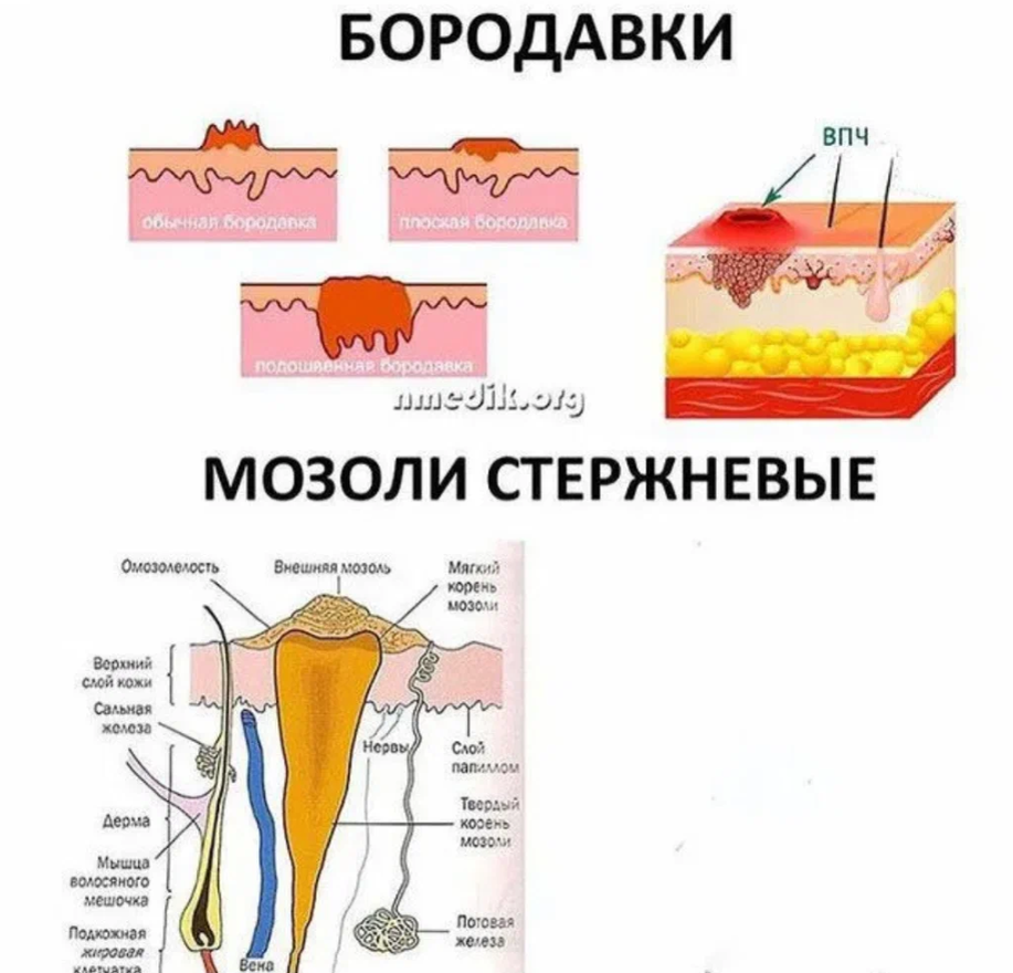 Подошвенная бородавка ✅⚕️ EllasesClinic ☎ Дерматология Урология Гинекология УЗИ