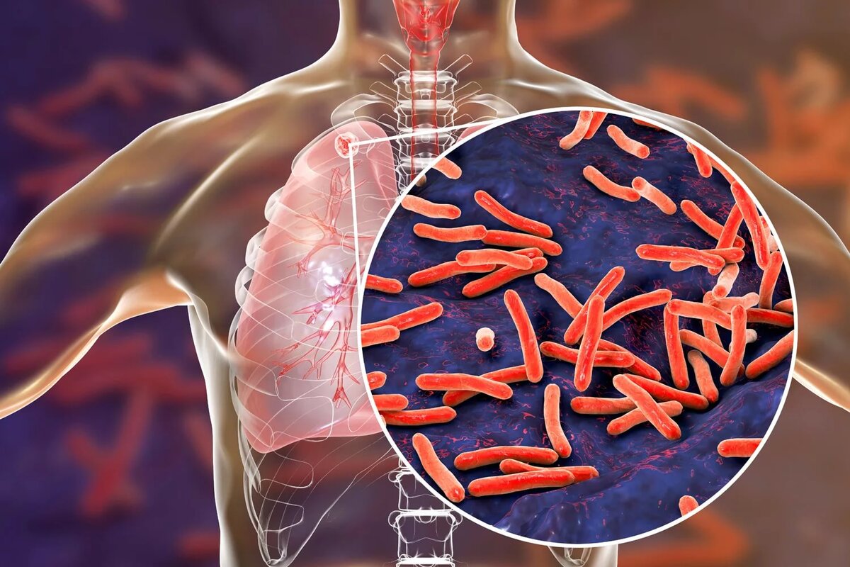 Возбудитель туберкулеза бактерия Mycobacterium tuberculosis