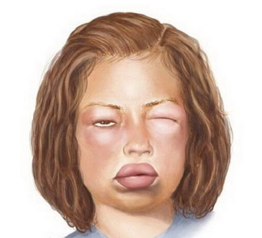 Так выглядит отёк Квинке