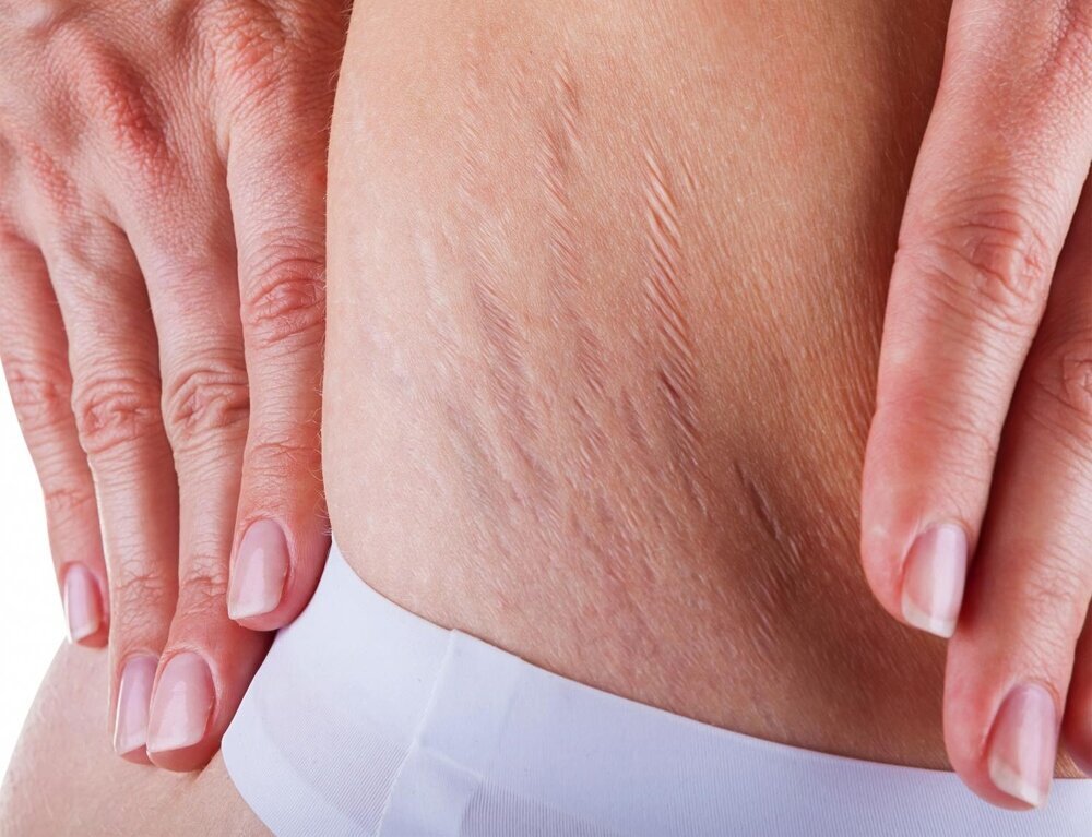 Как использовать эфирные масла от стрий для борьбы с растяжками в домашних условиях