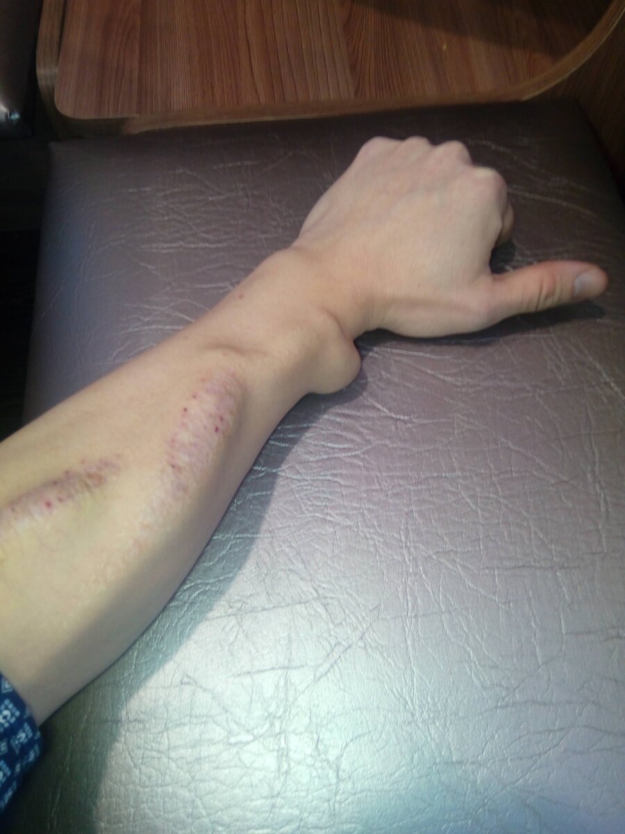 Моя фистула.