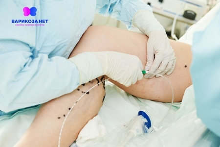 Врач делает прокол, через него в вену вводят световод, доставляющий лазерный луч к проблемному участку
