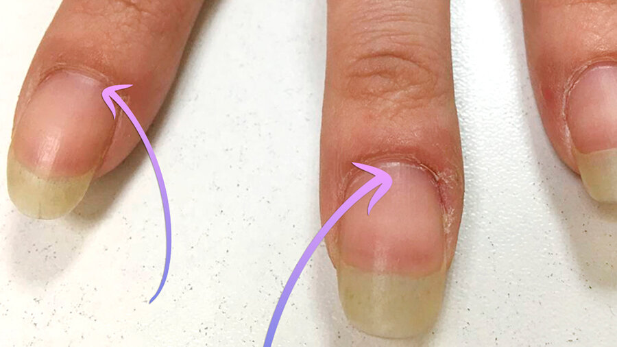 Причины и лечение борозд на ногтях