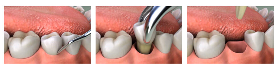 Процесс экстракции зуба. 