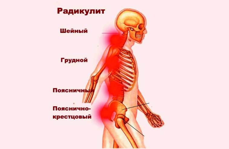 Что такое радикулит поясничный симптомы и лечение - что делать при радикулите