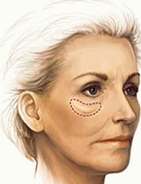 Ненавистный мешок под глазам