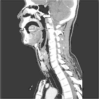 Имбибиция мягких тканей на кт. Мрт мягких тканей шеи снимки. Кт шеи без контраста. Мрт мягких тканей носоглотки. Кт шеи без контраста.