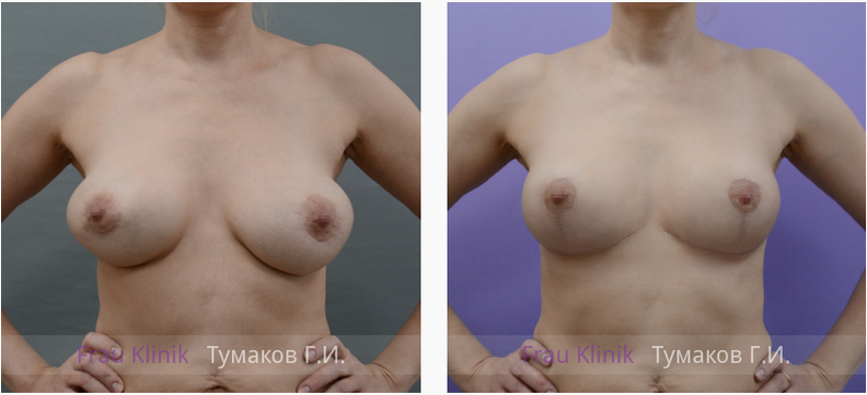 Повторная пластика груди после ее деформации