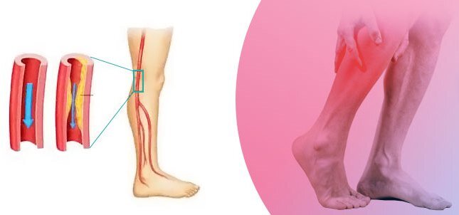 В мире от заболевания периферических артерий страдает более 200 млн. человек. Тем не менее,  оно многим неизвестно, а тяжесть его потенциальных осложнений часто недооценивается.