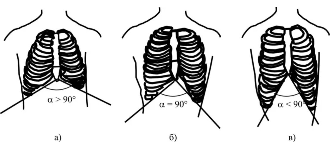 VARIANTS OF THE STRUCTURE OF THE EPIGASTRIC ANGLE.