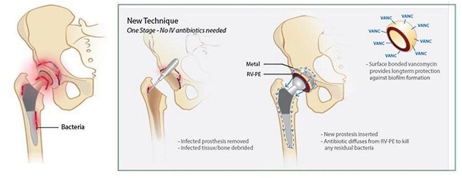 Новое покрытие эндопротеза снижает риск возникновения инфекции и ускоряет выздоровление. Источник фото https://medbe.ru/news/