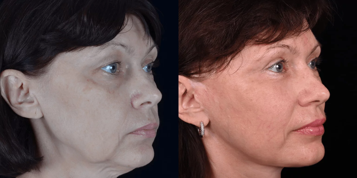 SMAS-подтяжка лица фото до и после. Фото с сайта Д.Р. Гришкяна. Имеются противопоказания, требуется консультация специалиста