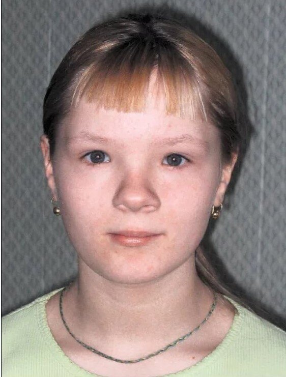 Девочка с алкогольным синдромом. ФАС (Фетальный алкогольный синдром)- различные по сочетанию и  по степени выраженности  психофизические отклонения в развитии ребенка, результатом которых является регулярный прием алкоголя до и во время беременности женщиной.