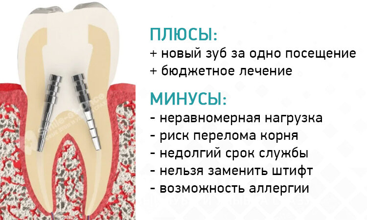 Пломба или восстановительная вкладка - плюсы и минусы, способы изготовления